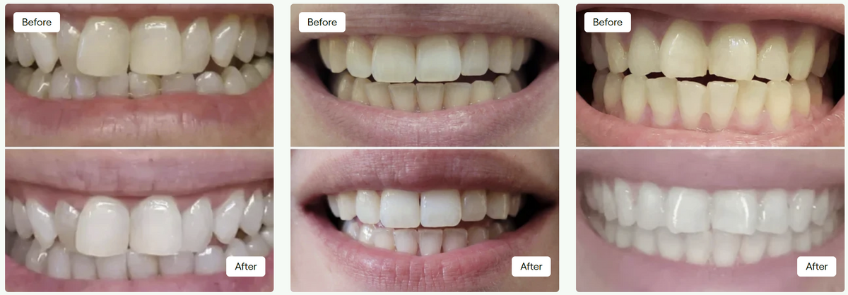 Before-and-after smile comparison 1, shared by customers and family.